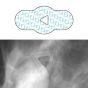 Spee-D-Angle™ Mammography Skin Marker Palpable Mass Radiolucent NO BURNOUT™ 3/8" Inner Diameter, 100 per Box
